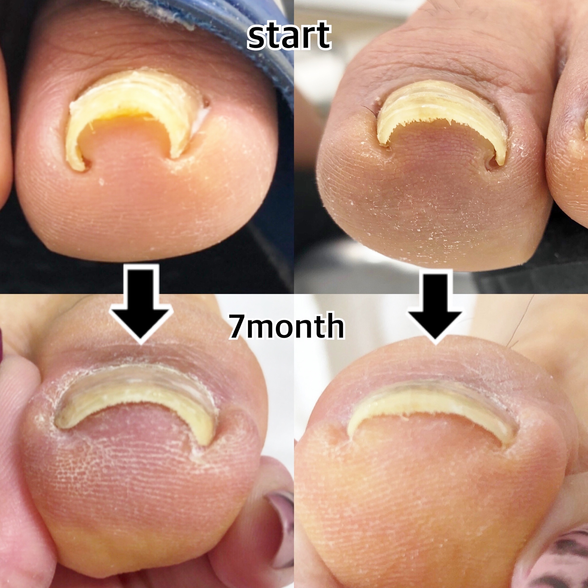 ◾️ BSブレイス ◾️ 巻き爪矯正 ネイルサロン - fawema.org